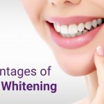 Teeth Whitening